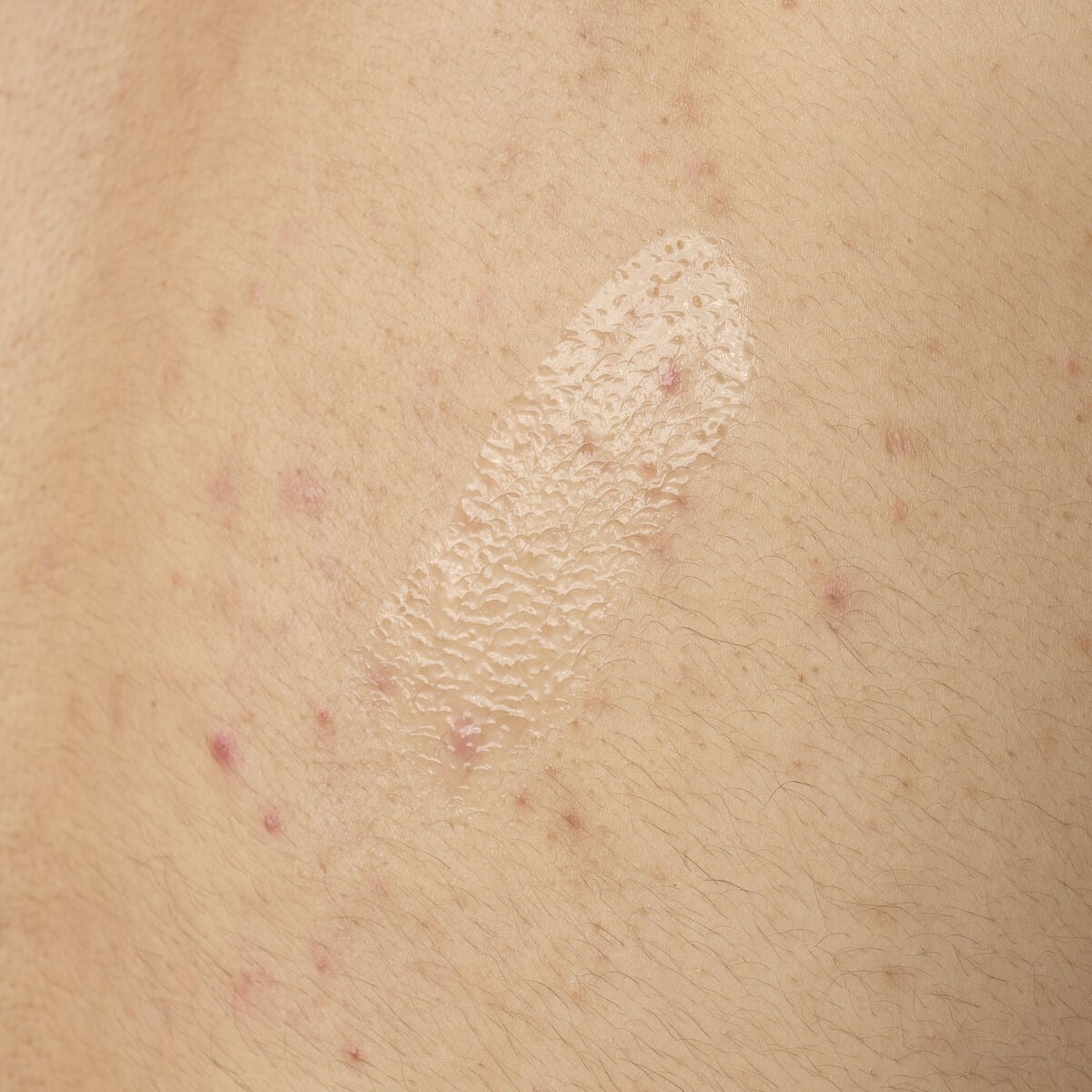 salicylic-acid-0-5-body-serum-c9 ORD-salicylic-acid-05-body-240ml-application.jpg