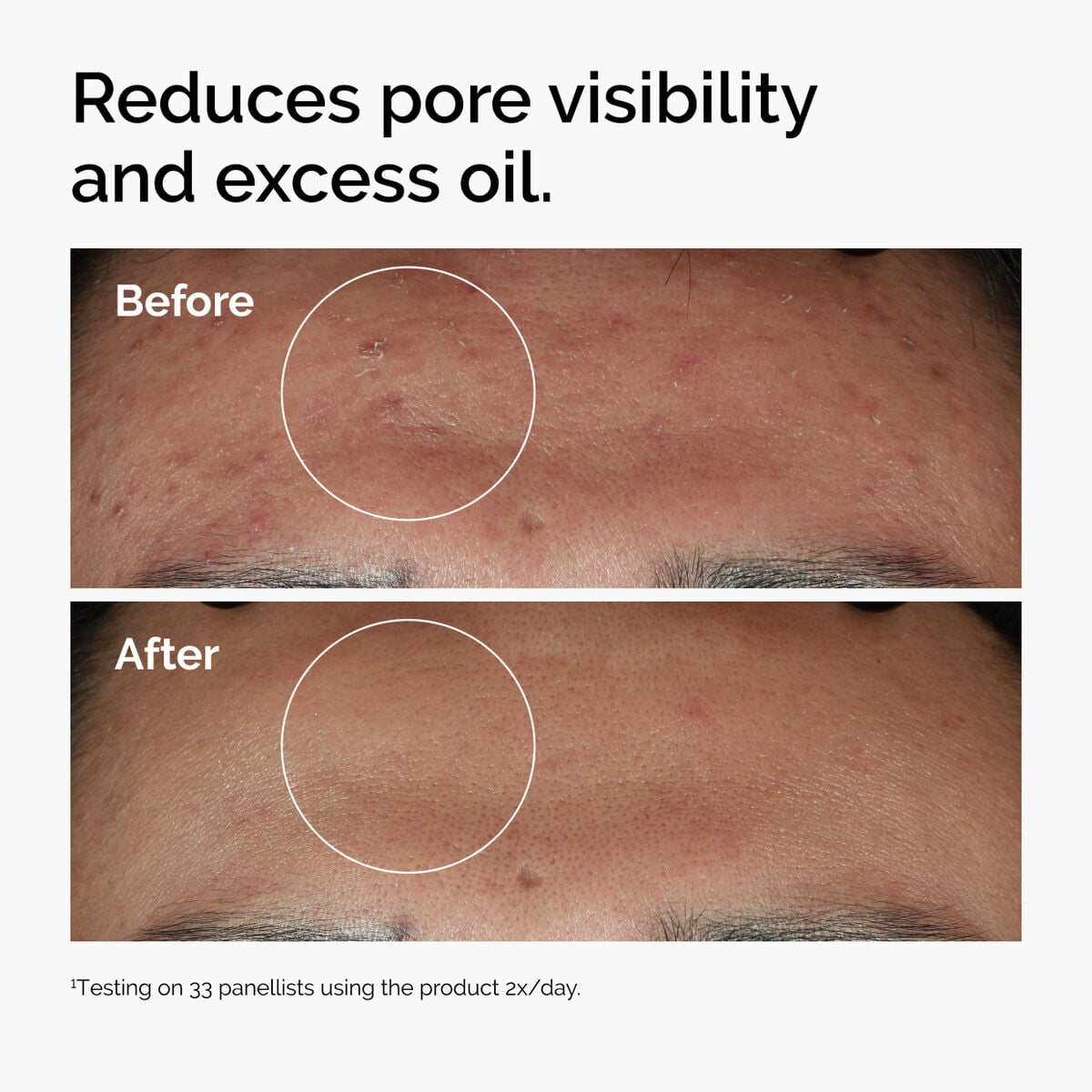 niacinamide-10-zinc-1-n6 ord-niacinamide-zinc-blemish-serum-before-after-pores.jpg