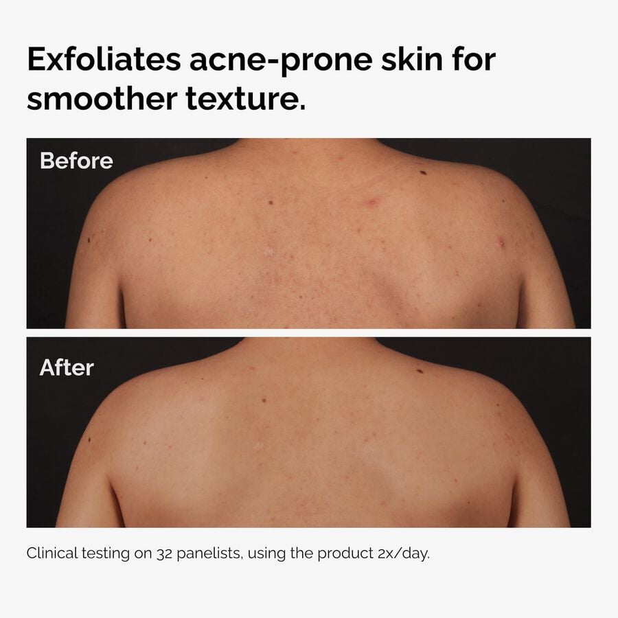the-body-care-collection-v5 ord-salicylic-acid-body-serum-before-after-graphic-NA.jpg