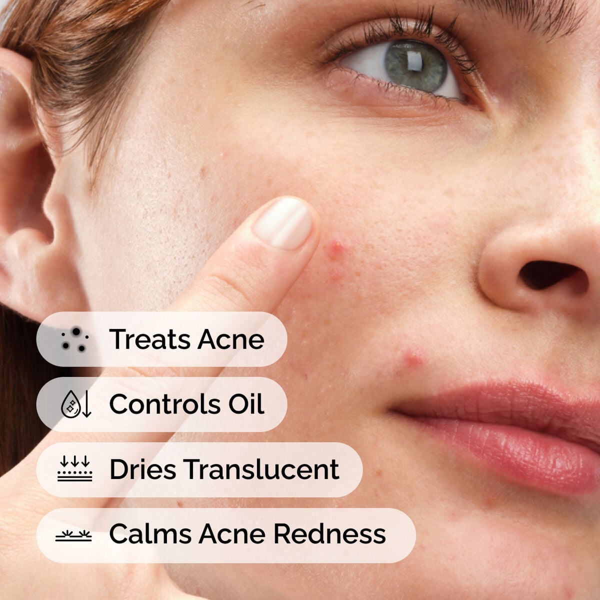 sulfur-10-powder-to-cream-concentrate-t6 ord-sulfur-10pct-powder-to-cream-concentrate-model-application-with-benefits-acne.jpg