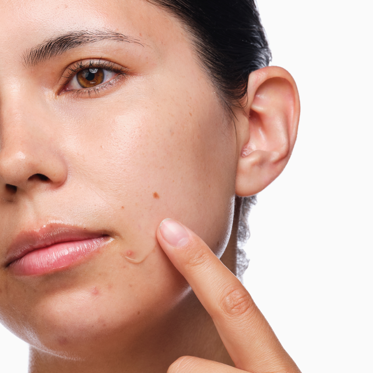 the-acne-set-t8 rdn-the-acne-set-application.png